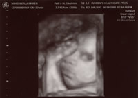 32 Week Ultrasound